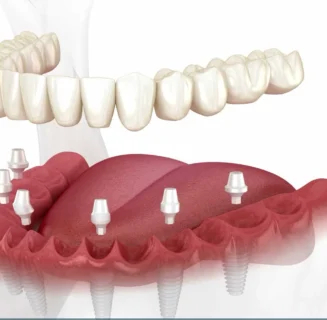 All-on-4 and All-on-6 full-arch dental implants
