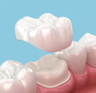 Zirconia and E-max dental crowns and bridges