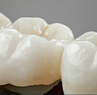 Zirconia and E-max dental crowns and bridges